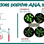 Antinuclear Antibodies ANA Test And Their Patterns ANA Test What Does ANA Test Positive Mean YouTube