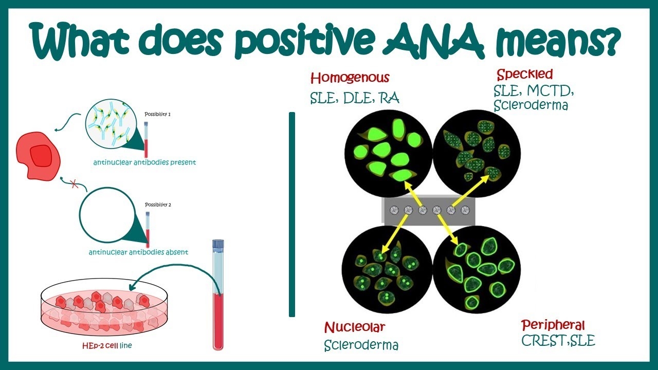 Antinuclear Antibodies ANA Test And Their Patterns ANA Test What Does ANA Test Positive Mean YouTube
