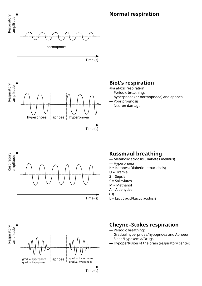 Cheyne Stokes Respiration Wikipedia Cheyne Stokes Respiration Wikipedia