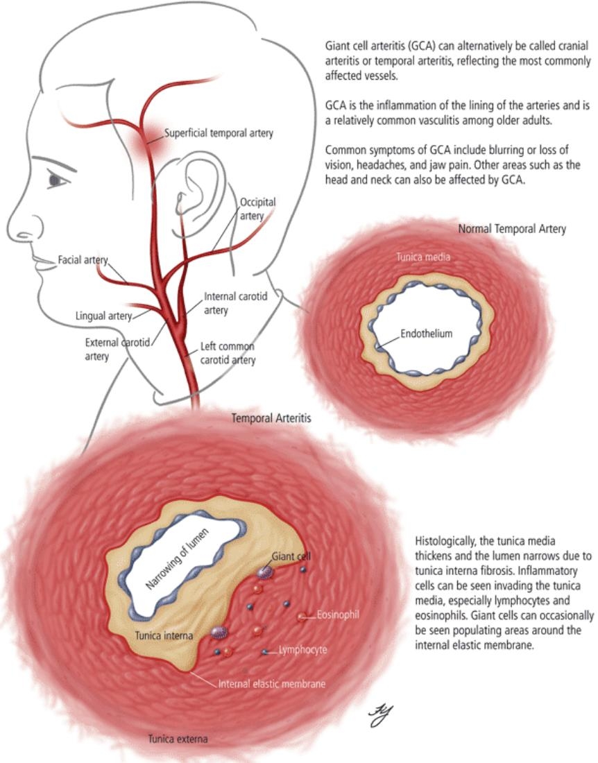 Cranial Temporal Arteritis Exodontia Cranial Temporal Arteritis Exodontia