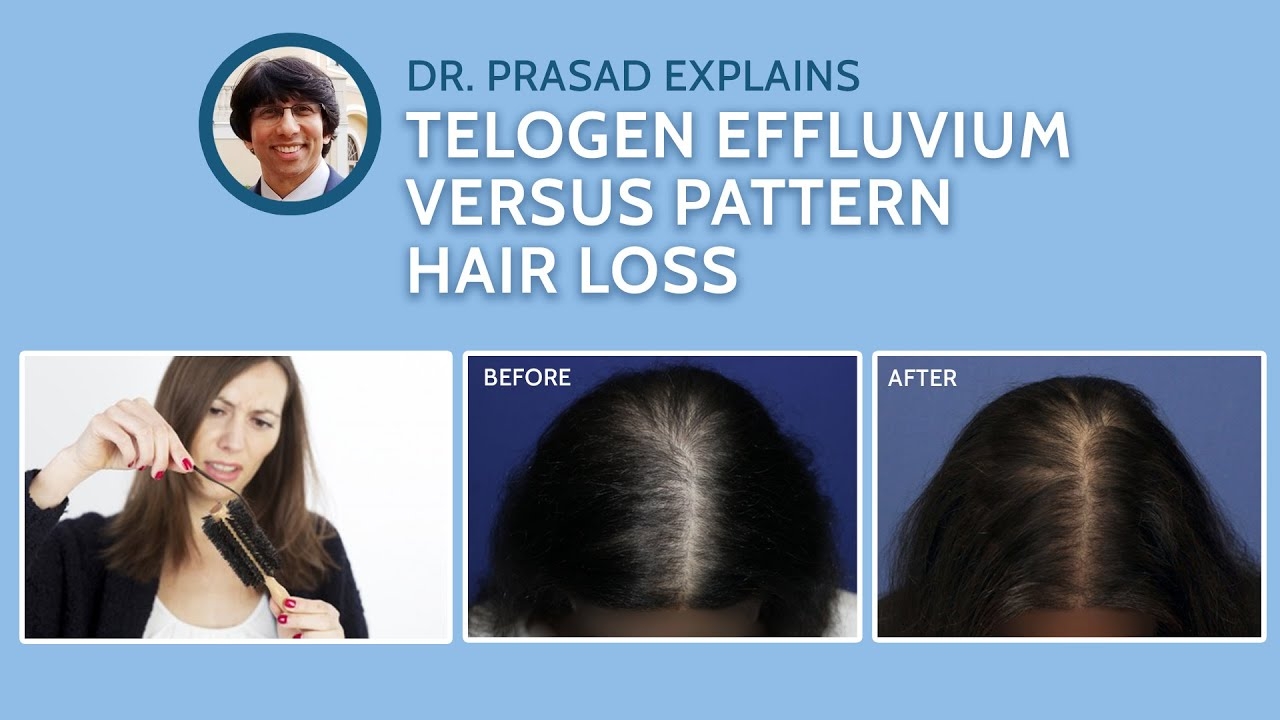 Differences Between Telogen Effluvium And Genetic Pattern Hair Loss YouTube Differences Between Telogen Effluvium And Genetic Pattern Hair Loss YouTube