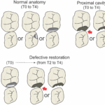 Does Treating Proximal Cavities In Primary Molars Non restoratively Affect Intra arch Space And Alignment Of Successor Teeth Negatively A 4 year Longitudinal Study PeerJ