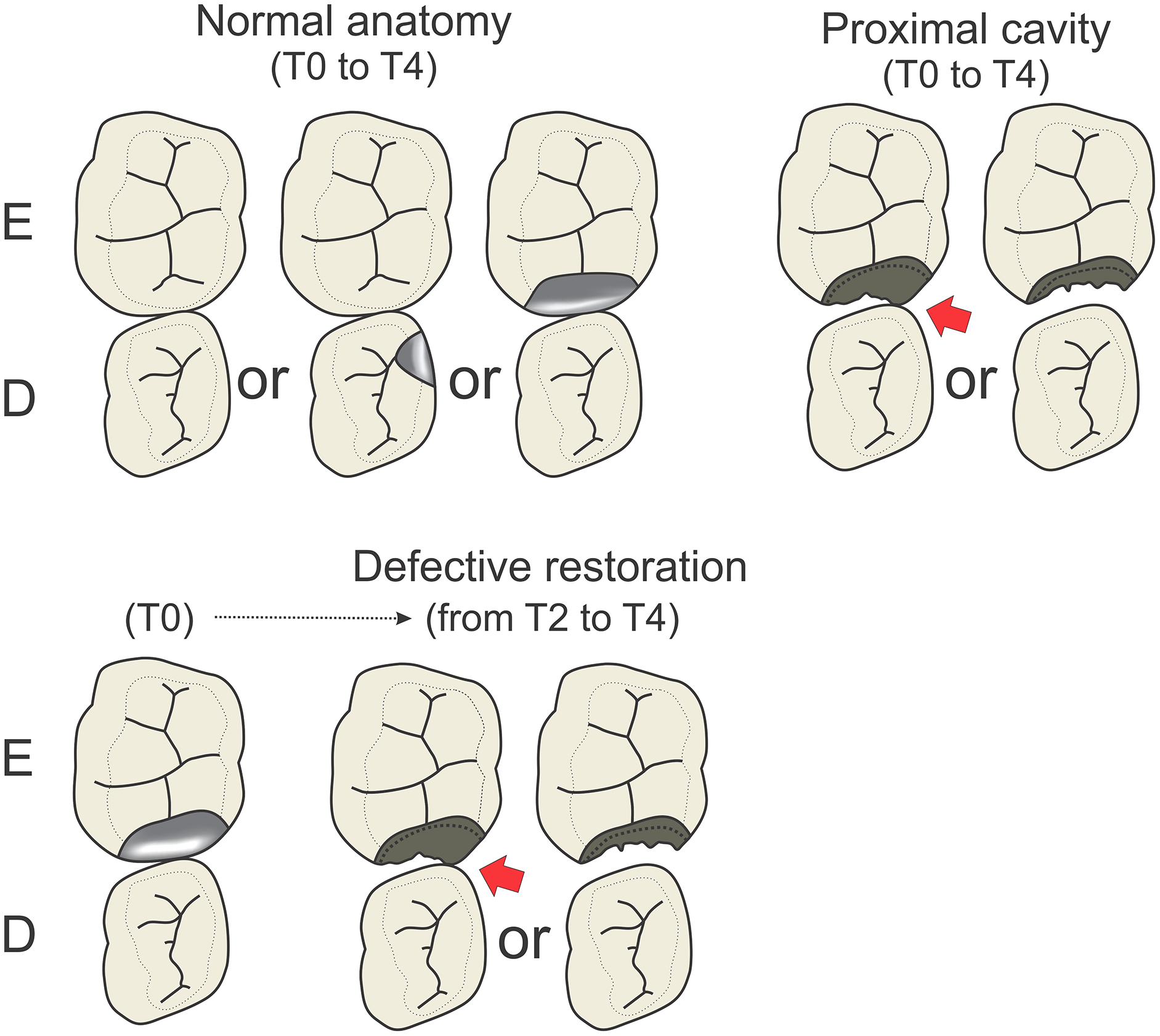 Does Treating Proximal Cavities In Primary Molars Non restoratively Affect Intra arch Space And Alignment Of Successor Teeth Negatively A 4 year Longitudinal Study PeerJ