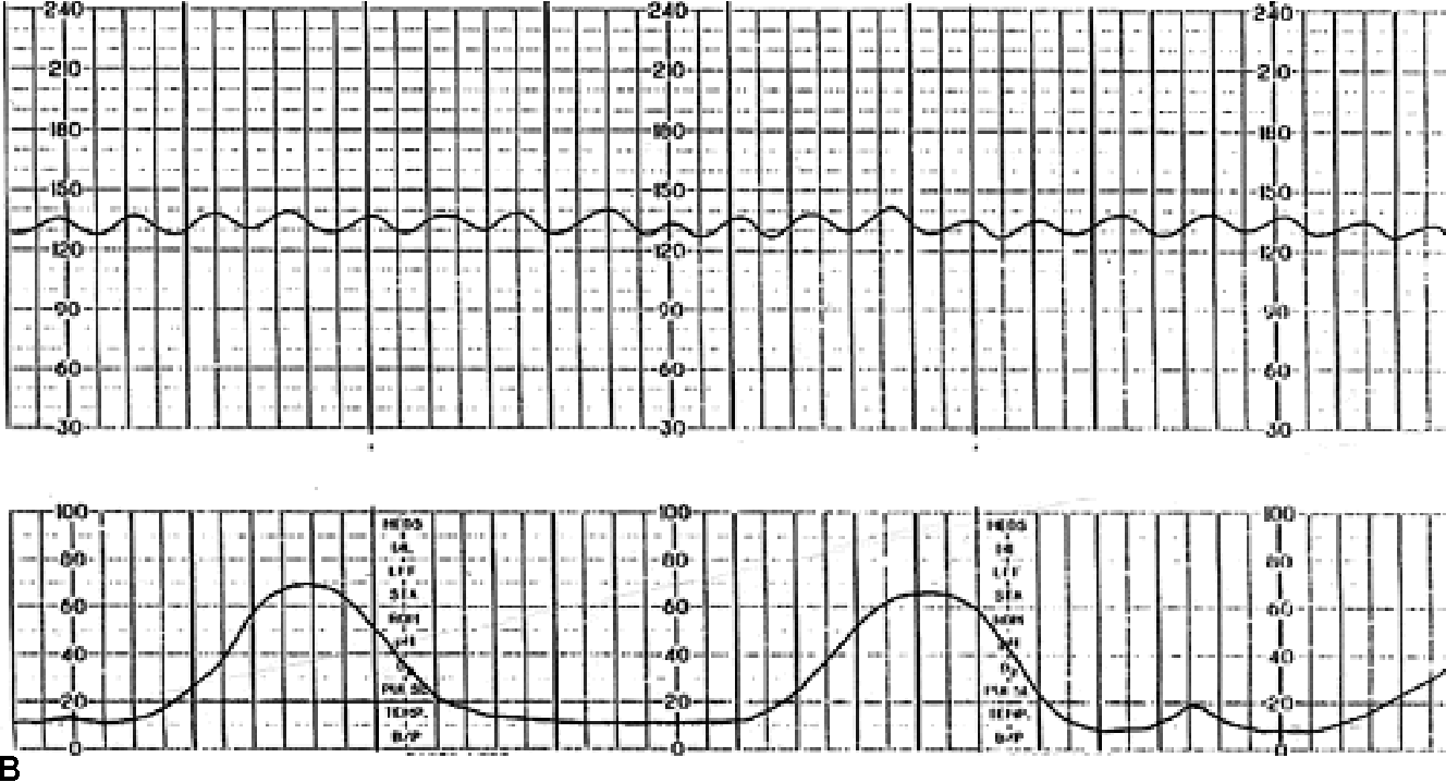 Figure 11 From Interpretation Of The Electronic Fetal Heart Rate During Labor Semantic Scholar