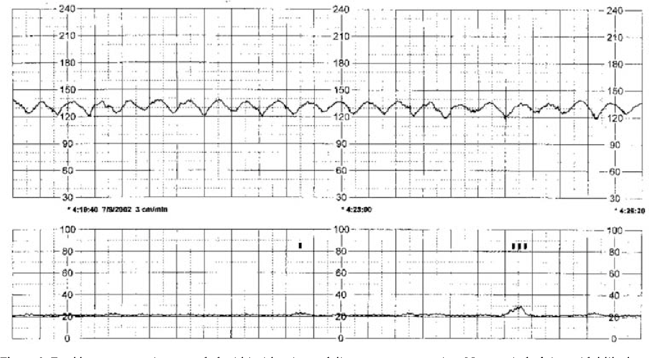 Figure 2 From Title Sinusoidal Heart Rate Pattern Reappraisal Of Its Definition And Clinical Significance Semantic Scholar