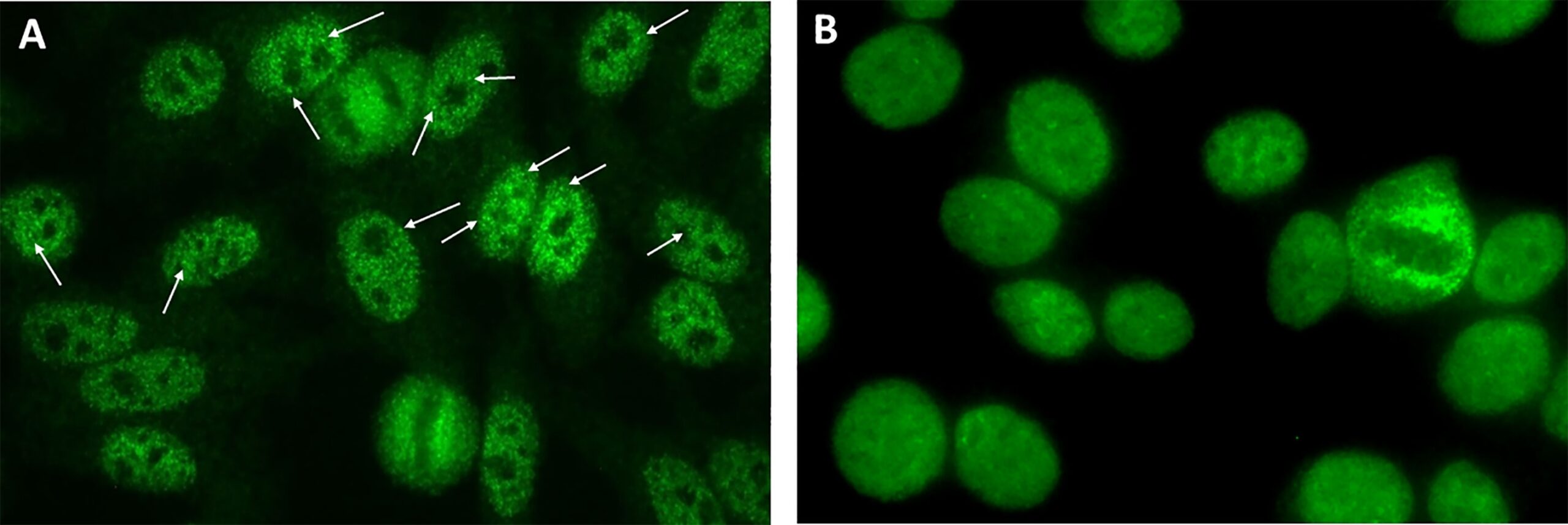 Frontiers Strong Association Of The Myriad Discrete Speckled Nuclear Pattern With Anti SS A Ro60 Antibodies Consensus Experience Of Four International Expert Centers