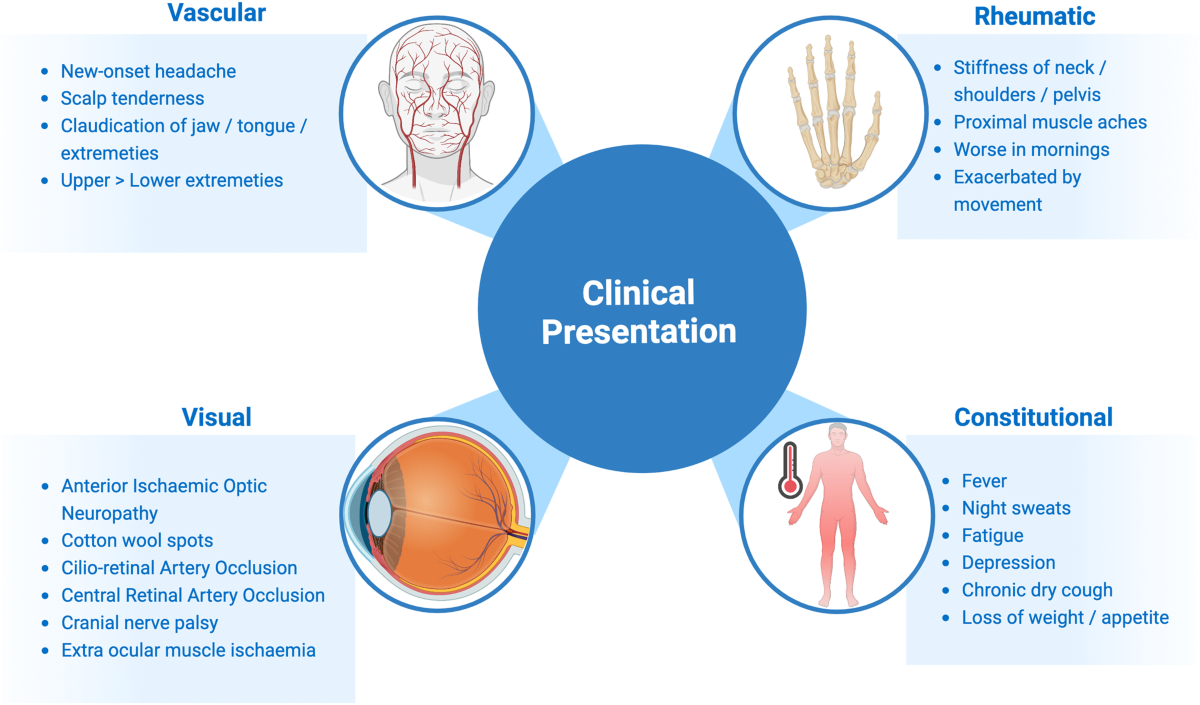 Giant Cell Arteritis Reviewing The Advancing Diagnostics And Management Eye Giant Cell Arteritis Reviewing The Advancing Diagnostics And Management Eye