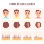 Hair Loss In Women Female Pattern Baldness HTN