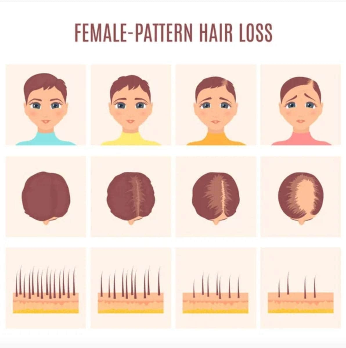 Hair Loss In Women Female Pattern Baldness HTN