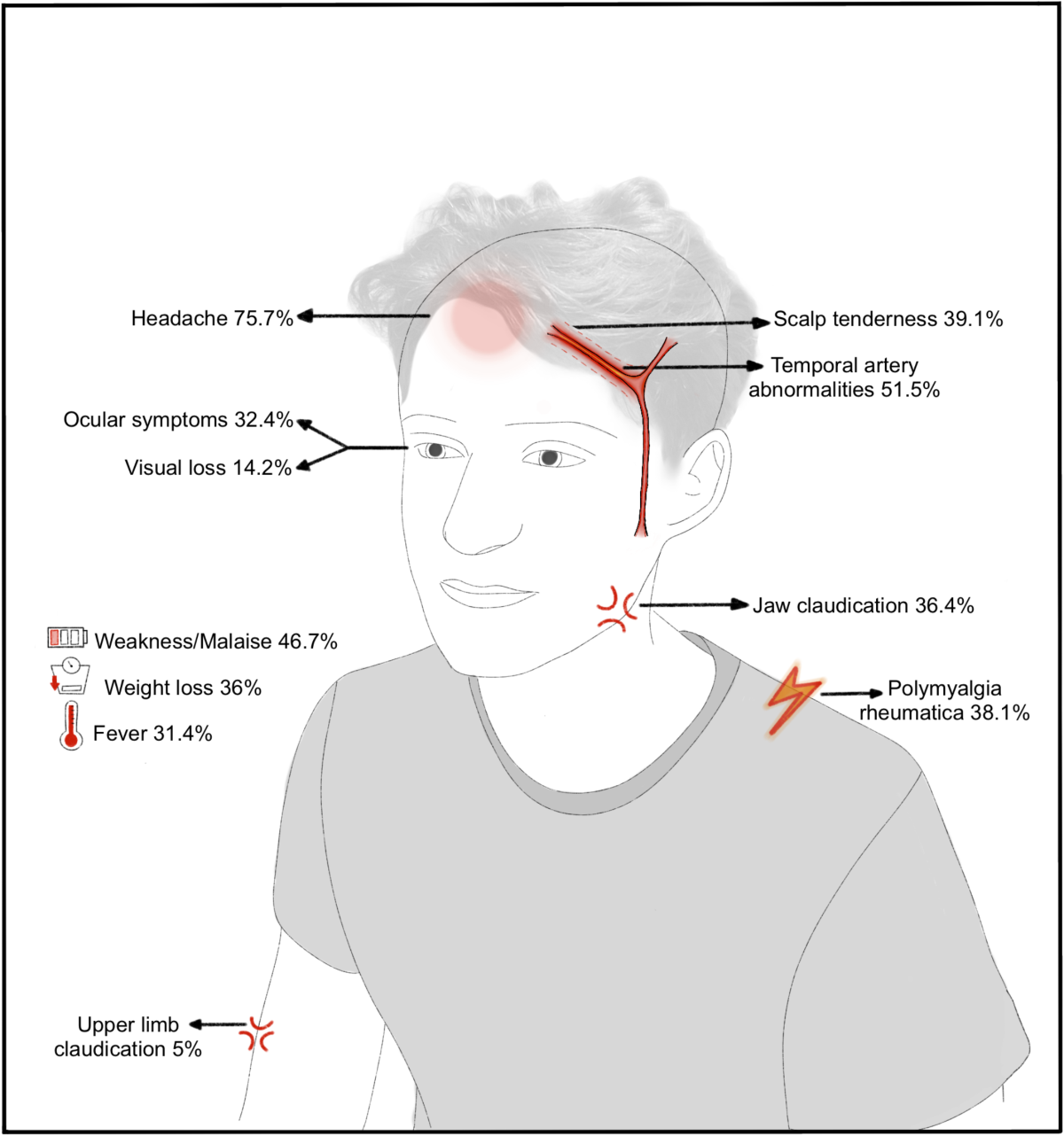 Headache As The Most Common Manifestation Of Giant Cell Arteritis A Systematic Review With Meta analysis Rheumatology International Headache As The Most Common Manifestation Of Giant Cell Arteritis A Systematic Review With Meta analysis Rheumatology International