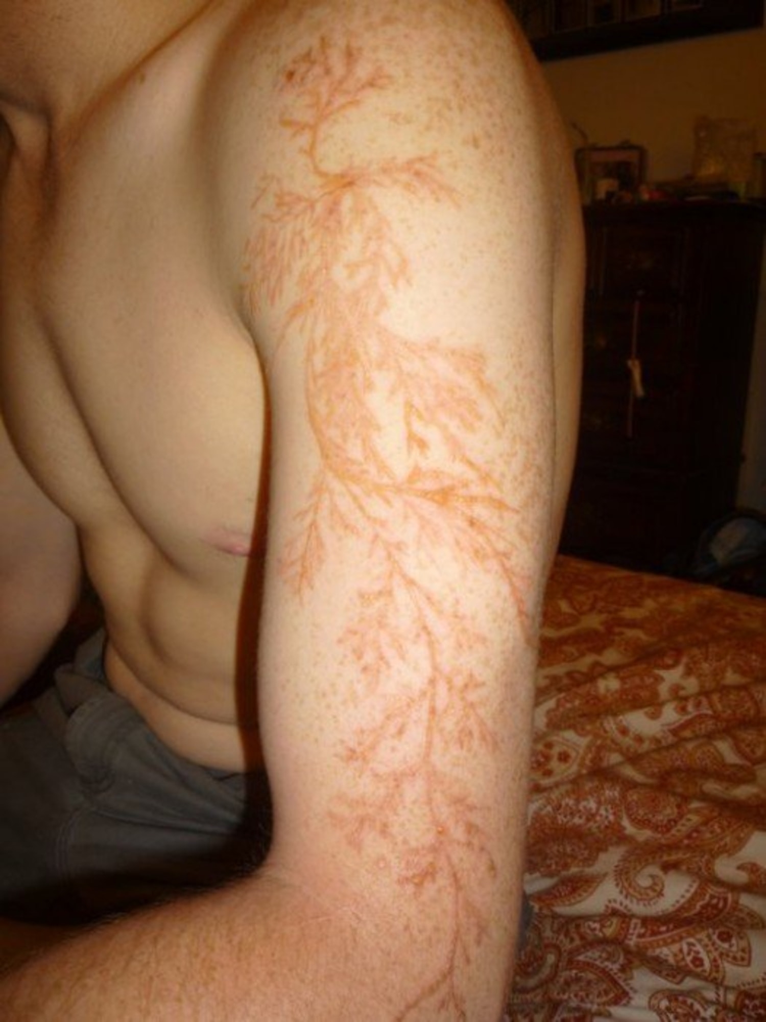 Here s What A Lightning Strike Can Do To Your Skin