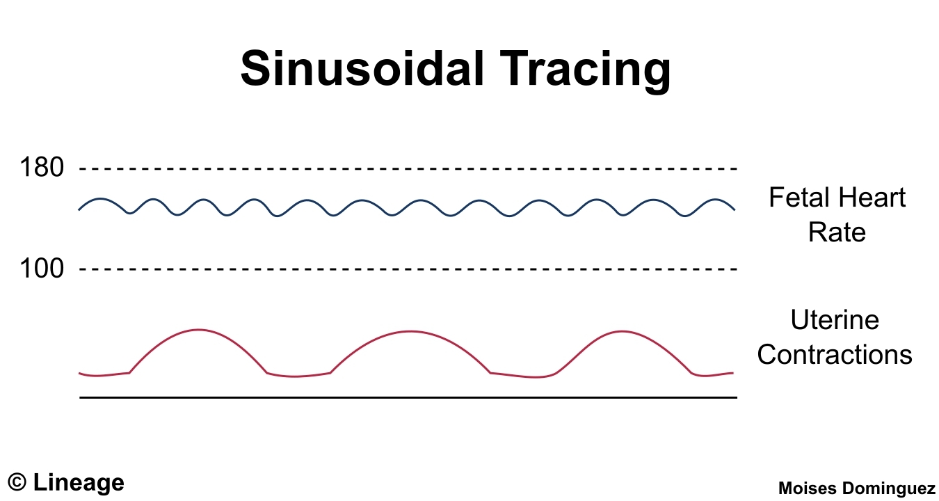 Intrapartum Fetal Assessment Obstetrics Medbullets Step 2 3