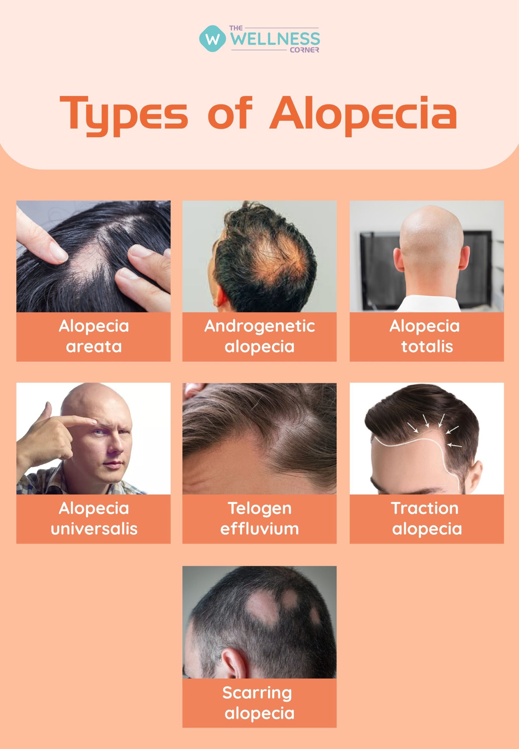 Losing Hair Here s Everything You Need To Know About Alopecia The Wellness Corner Losing Hair Here s Everything You Need To Know About Alopecia The Wellness Corner