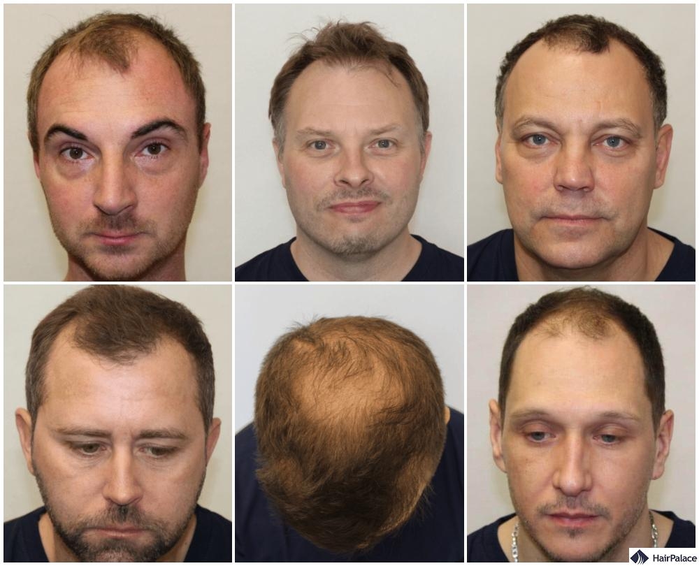 male pattern baldness stages