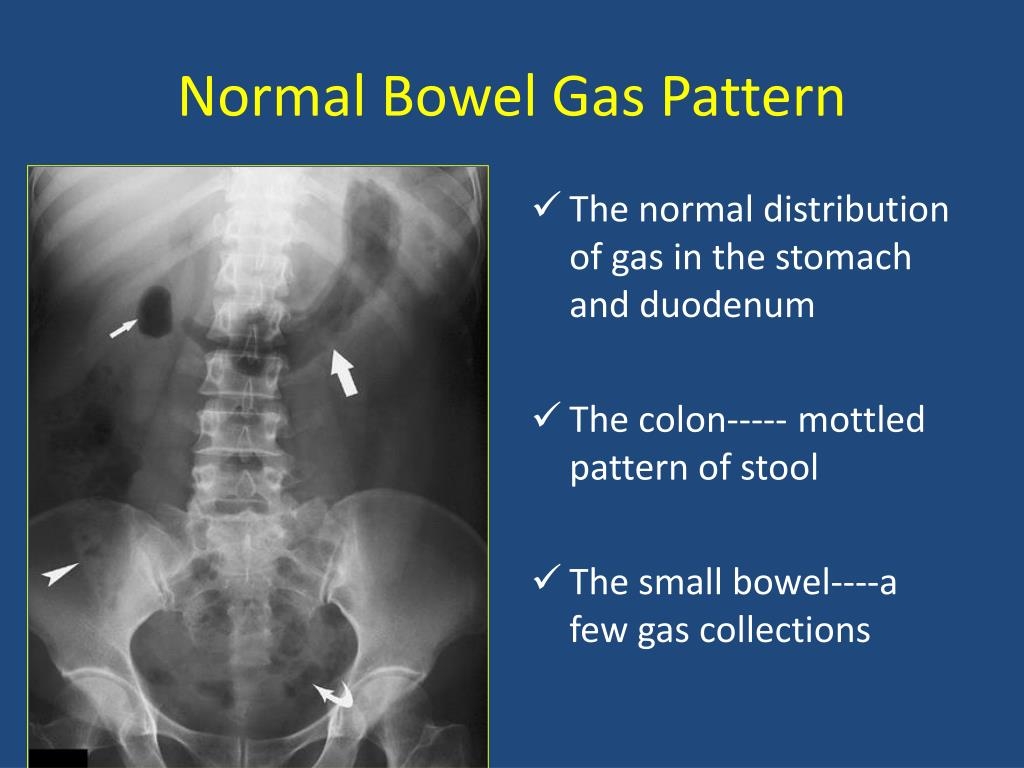 Non Obstructive Bowel Gas Pattern Treatment Www lx iriss uk Non Obstructive Bowel Gas Pattern Treatment Www lx iriss uk
