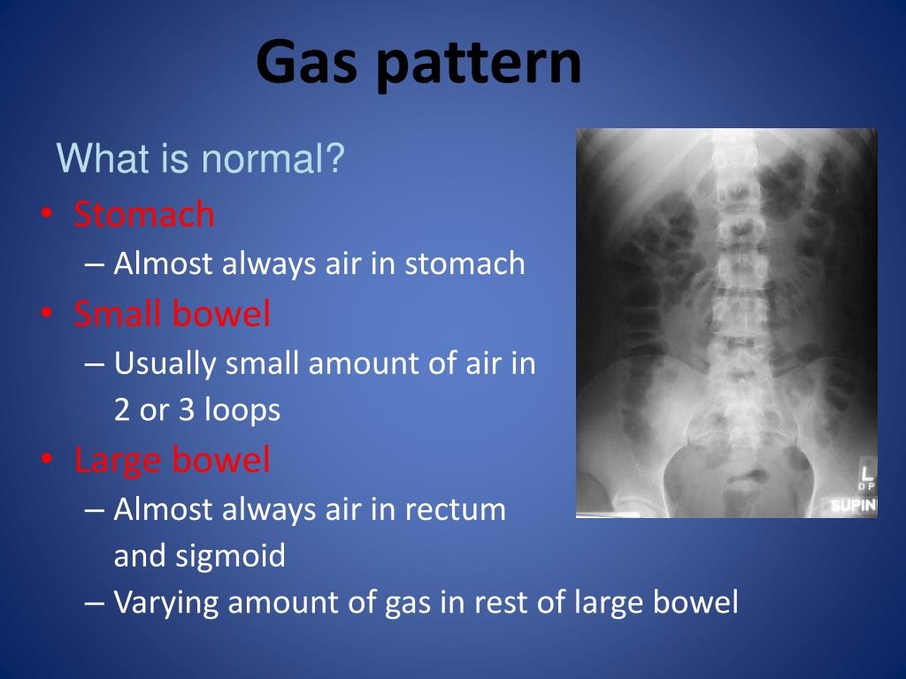 Non Specific Bowel Gas Pattern Www lx iriss uk Non Specific Bowel Gas Pattern Www lx iriss uk