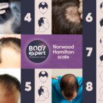 Norwood Hamilton Scale The 7 Stages Of Male Pattern Baldness