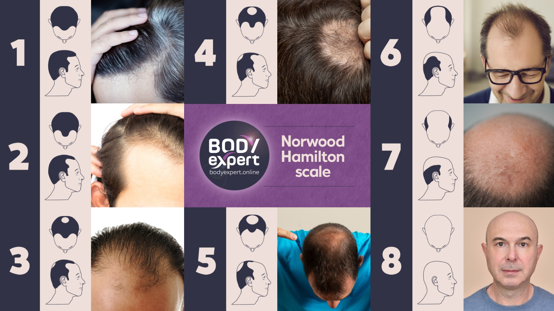 Norwood Hamilton Scale The 7 Stages Of Male Pattern Baldness
