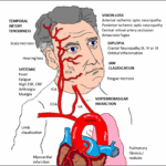 One Giant Step For Giant Cell Arteritis Updates In Diagnosis And Treatment Current Treatment Options In Neurology
