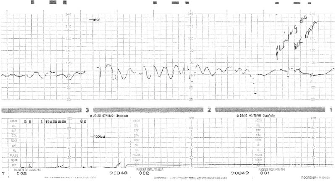 PDF Title Sinusoidal Heart Rate Pattern Reappraisal Of Its Definition And Clinical Significance Semantic Scholar