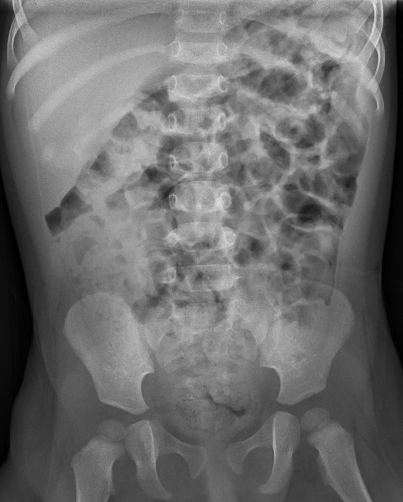 Pediatric Abdominal Pain Radiology Key Pediatric Abdominal Pain Radiology Key