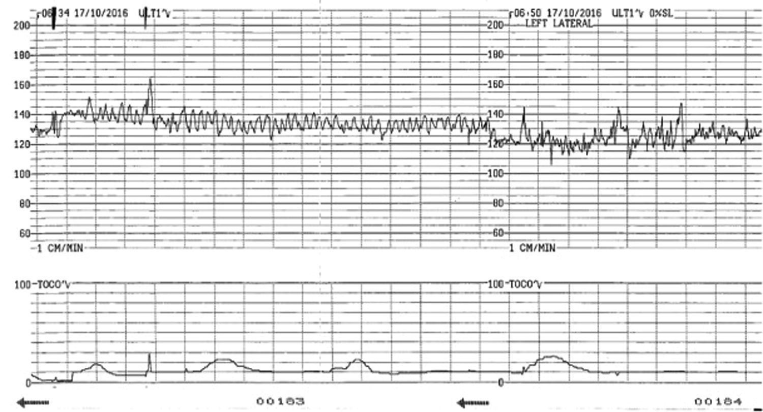 sinusoidal fetal heart rate pattern