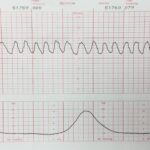 Sinusoidal Pattern Military Obstetrics Gynecology 3rd Edition