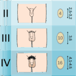 Tanner Scale Wikipedia