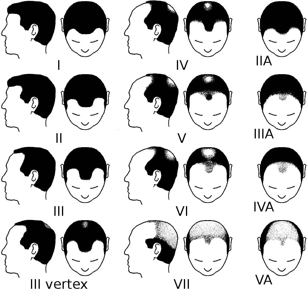 The Norwood Scale Hair Shedding Classification Stages 1 7