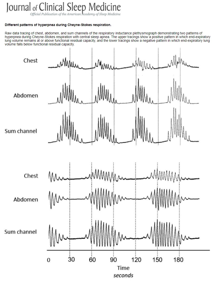 Two Distinct Patterns Of Hyperpnea During Cheyne Stokes Respiration Implication For Cardiac Function In Patients With Heart Failure Thoracic And Sleep Group Queensland Two Distinct Patterns Of Hyperpnea During Cheyne Stokes Respiration Implication For Cardiac Function In Patients With Heart Failure Thoracic And Sleep Group Queensland