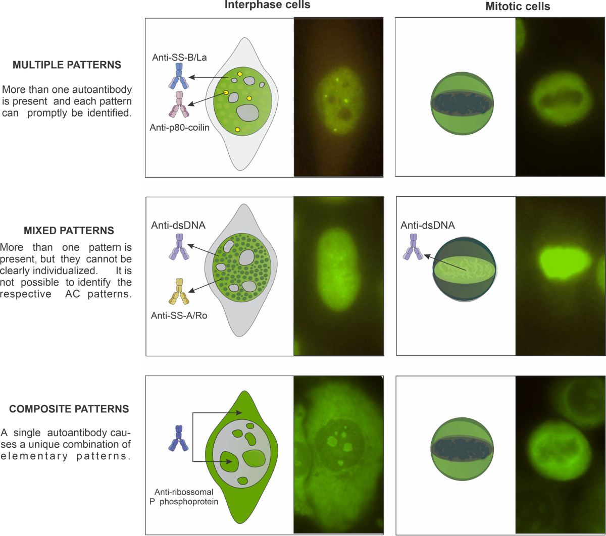 VI Brazilian Consensus Guidelines For Detection Of Anti cell Autoantibodies On HEp 2 Cells Advances In Rheumatology Full Text VI Brazilian Consensus Guidelines For Detection Of Anti cell Autoantibodies On HEp 2 Cells Advances In Rheumatology Full Text