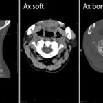 Cervical Spine CT computed Tomography Radiology Search Pattern YouTube