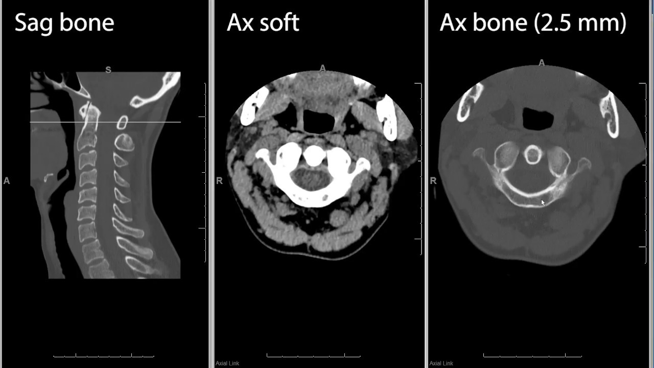 Cervical Spine CT computed Tomography Radiology Search Pattern YouTube