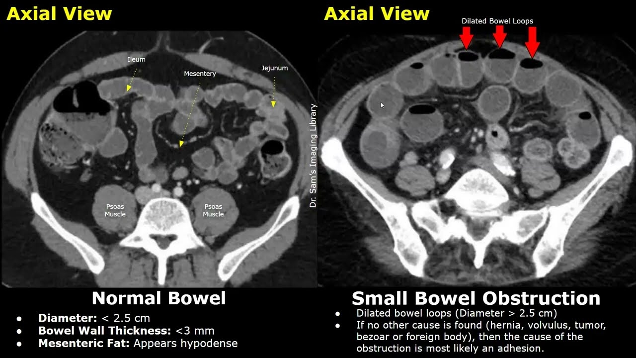 CT Abdomen Normal Bowel Vs Small Bowel Obstruction Adhesions Volvulus Hernia Other Causes YouTube CT Abdomen Normal Bowel Vs Small Bowel Obstruction Adhesions Volvulus Hernia Other Causes YouTube